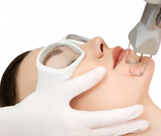 Fractional Laser 1