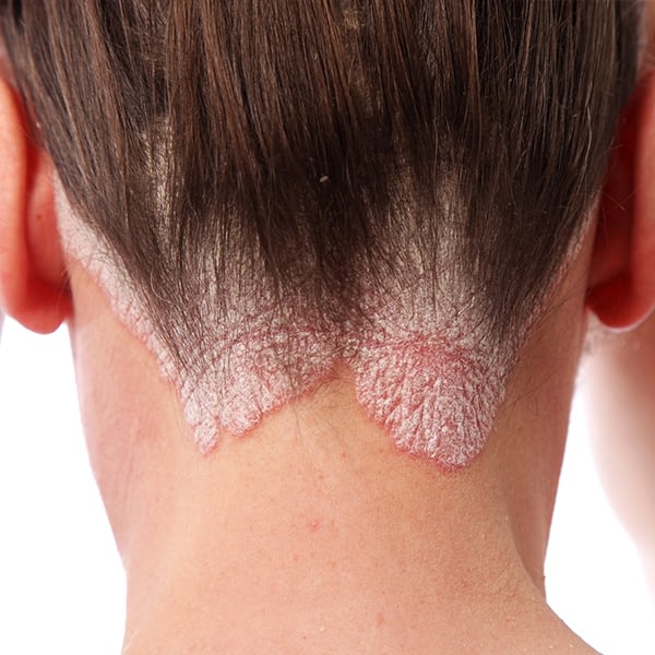 psoriasi