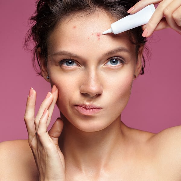 acne 1