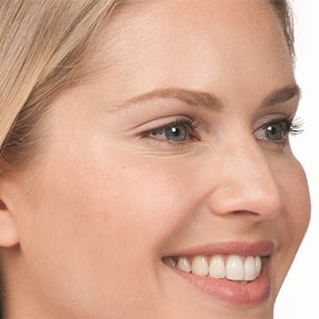 botox-after-1