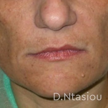 fillers1-before-1