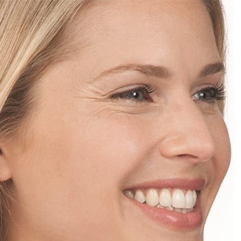 botox-before
